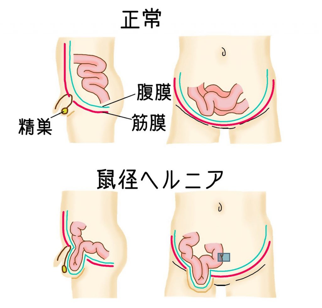 鼠径 ヘルニア 原因